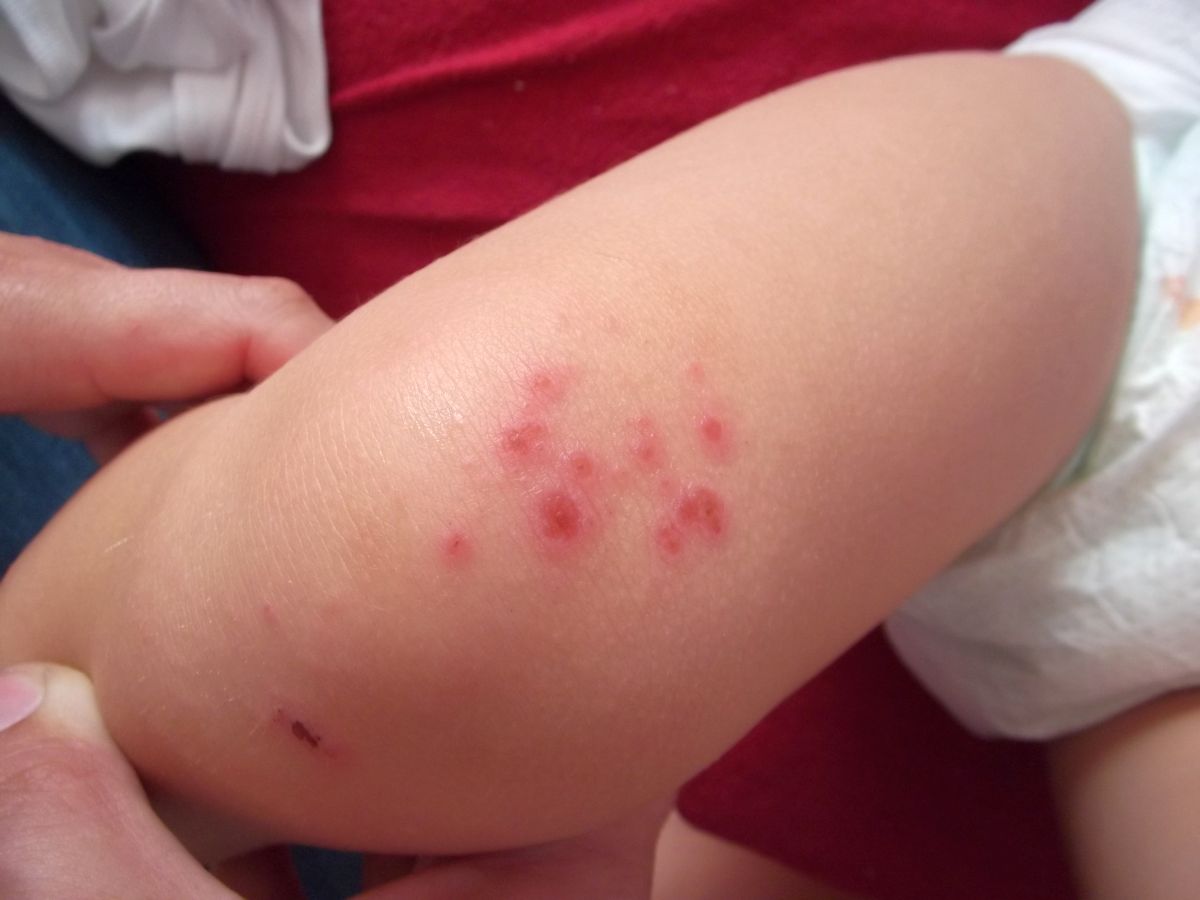 Comment Identifier Une Piqure Ou Un Bouton De La Punaise De Lit Anti Punaise Puce
